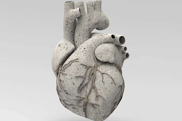 calcified heart