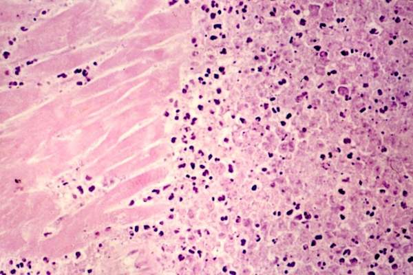 Microscopic image of heart tissue 72 hours after acute myocardial infarction