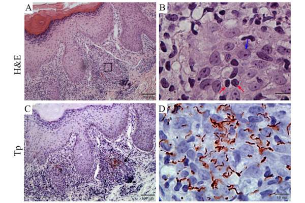 Micrograph of secondary syphilis