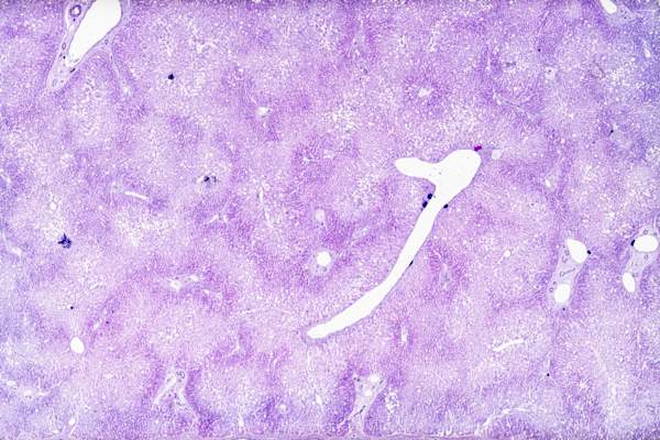 Fatty liver degeneration under microscope
