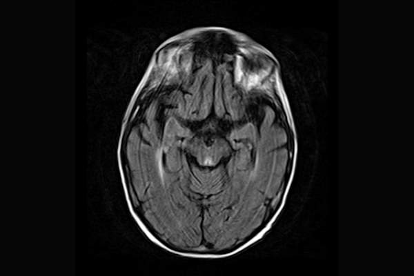 MRI FLAIR sequence showing hyperintense signal in the periaqueducal grey matter in Wernicke Encephalopathy