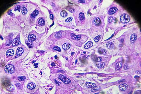 hepatocellular carcinoma