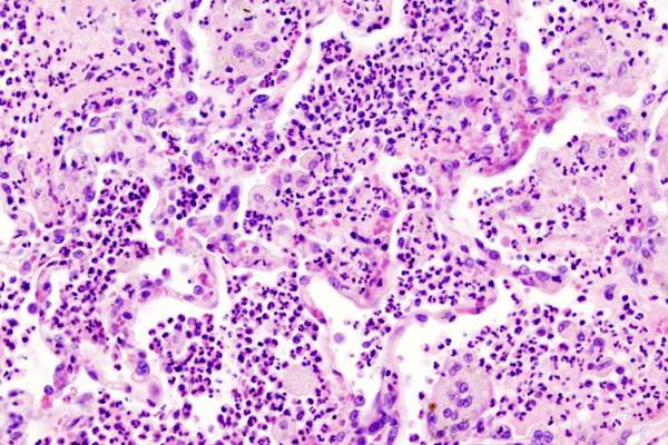 Histopathologic image of aspiration pneumonia
