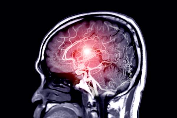 stroke