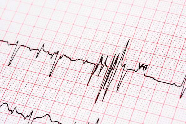 Electrocardiogram Paper results