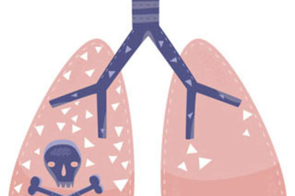 COPD May Be Common and Underdiagnosed in People Living With HIV