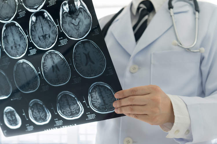 Doctor looking at brain scan