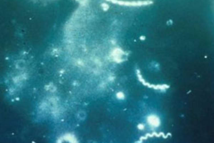 Basic Questions and Answers About Syphilis Img