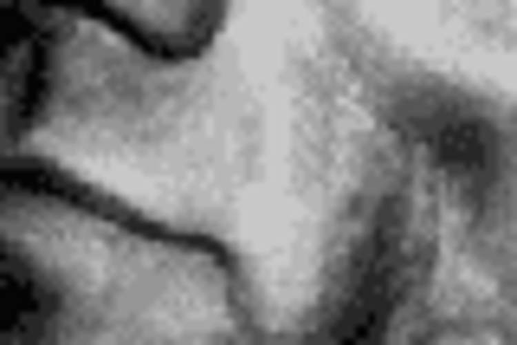 Facial Lipoatrophy Treatments: Help Us Remove Barriers to Access Img