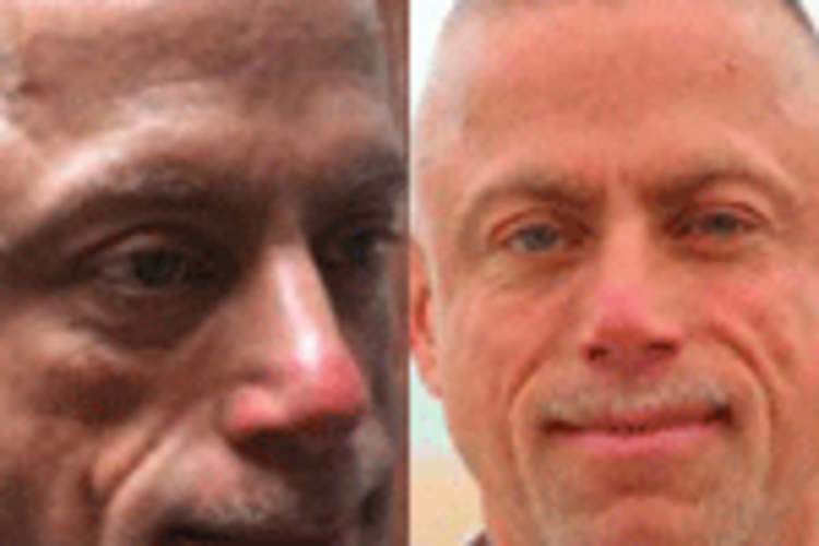 The Mirror Has Two Faces: A Personal Account of Using Facial Filler for Lipoatrophy Img