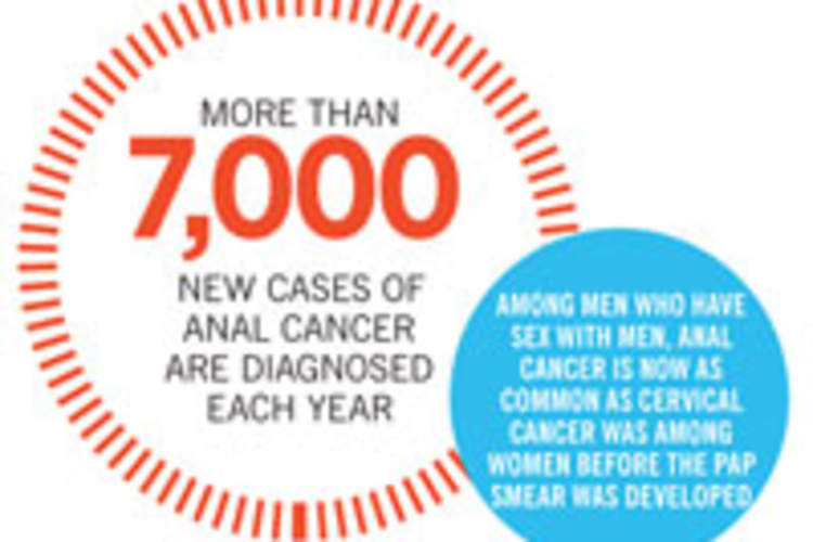 Anal Cancer: Are You at Risk? Img