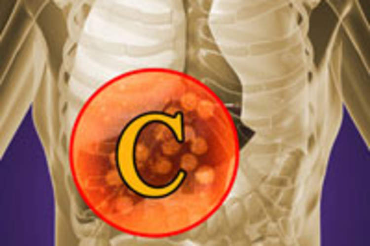 I Have Hepatitis C. What Are My Treatment Options? Img