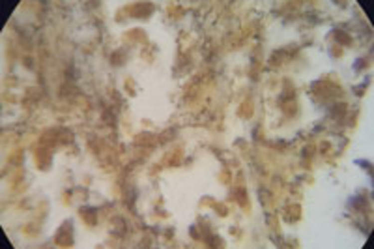2 Washington State Men Blind From Rare Ocular Syphilis Img