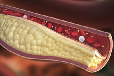 Hepatitis C and HIV Each Linked to Artery Plaque Buildup in Gay Men Img