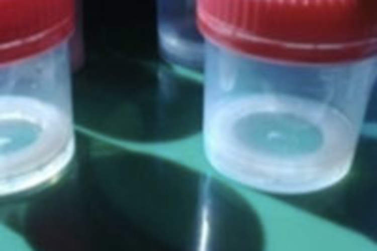 Vaginal Ring Reduces HIV: Making Sense of the Initial Results Img
