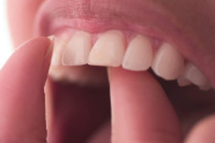 Is There an Over-the-Counter Treatment for Oral Thrush? Img