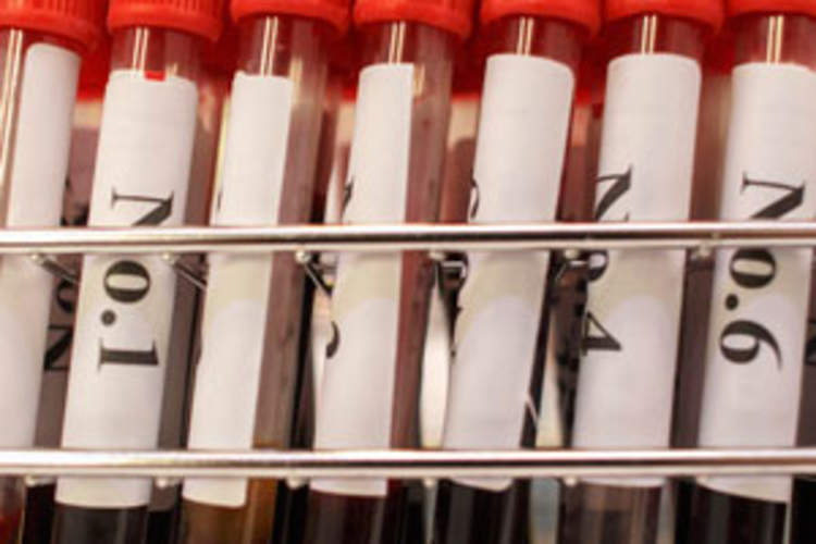Will HIV Show Up on Normal Blood Work? Img