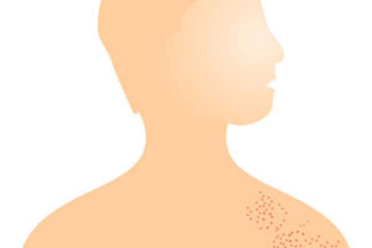 Meningitis Clusters Are Real -- and Potentially Deadly Img