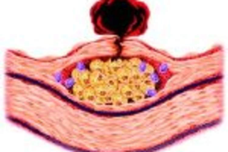 Chronic Inflammation in People With HIV Linked to Pre-Treatment Immune System Damage Img