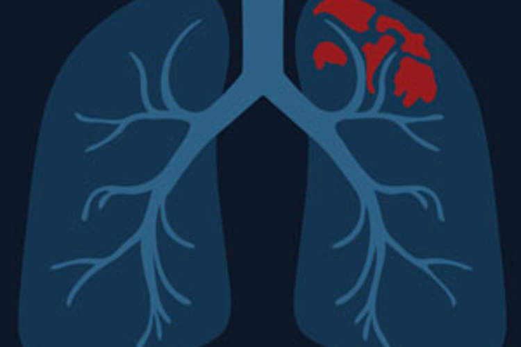 An Opportunity to End Two of the World's Deadliest Infectious Diseases: TB and HIV Img