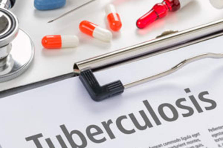 TB Causes 1 in 3 HIV Deaths Img