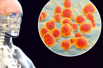 Cryptococcal Screening in Patients With HIV Img