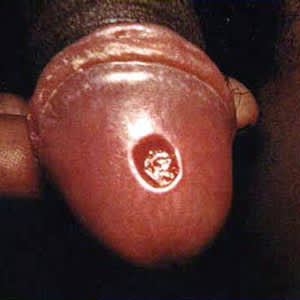 Example of a primary syphilis sore