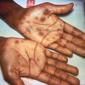 Secondary rash from syphilis on palms of hands