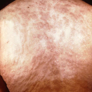 Secondary rash from syphilis on torso