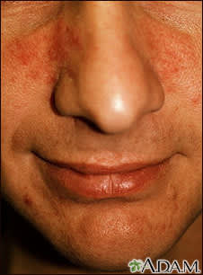 Justin vs. Rosacea