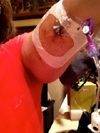 Picc line last time I was on IV meds.