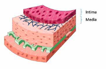 Carotid Intima-Media Thickness (cIMT)