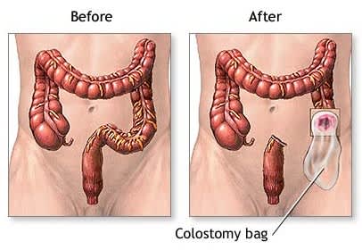 Colostomy/Stoma Operation