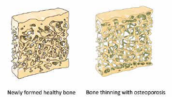 Healthy Bone and Osteoporosis