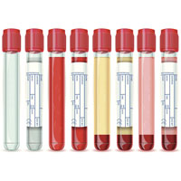 After Battle With Hemophilia, HIV and Hepatitis C, Two of Them Are No Longer a Problem
