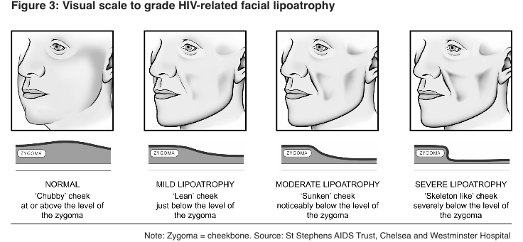 Figure 3. Visual Scale to Grade HIV-Related Facial Lipoathrophy