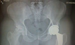 Charles' x-ray: one hip, two hip, old hip, new hip! (Credit: Charles Sanchez)