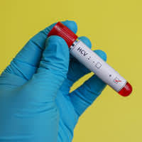 Hepatitis C: Behind New Wonder Drugs Lies a Terrible Dilemma