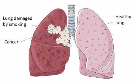CT Scans Can Detect Lung Cancer in Middle-Aged Smokers With HIV
