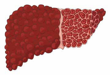 Two Tests Offer Early Signals of Liver Fibrosis