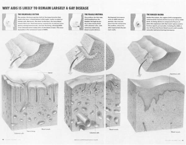 'Why AIDS is likely to remain largely a gay disease,' illustration by Lewis Calver for Discover, December 1985 (Paula Treichler, 'AIDS, Homophobia, and Biomedical Discourse: An Epidemic of Signification.' October 43 (1987), 38)