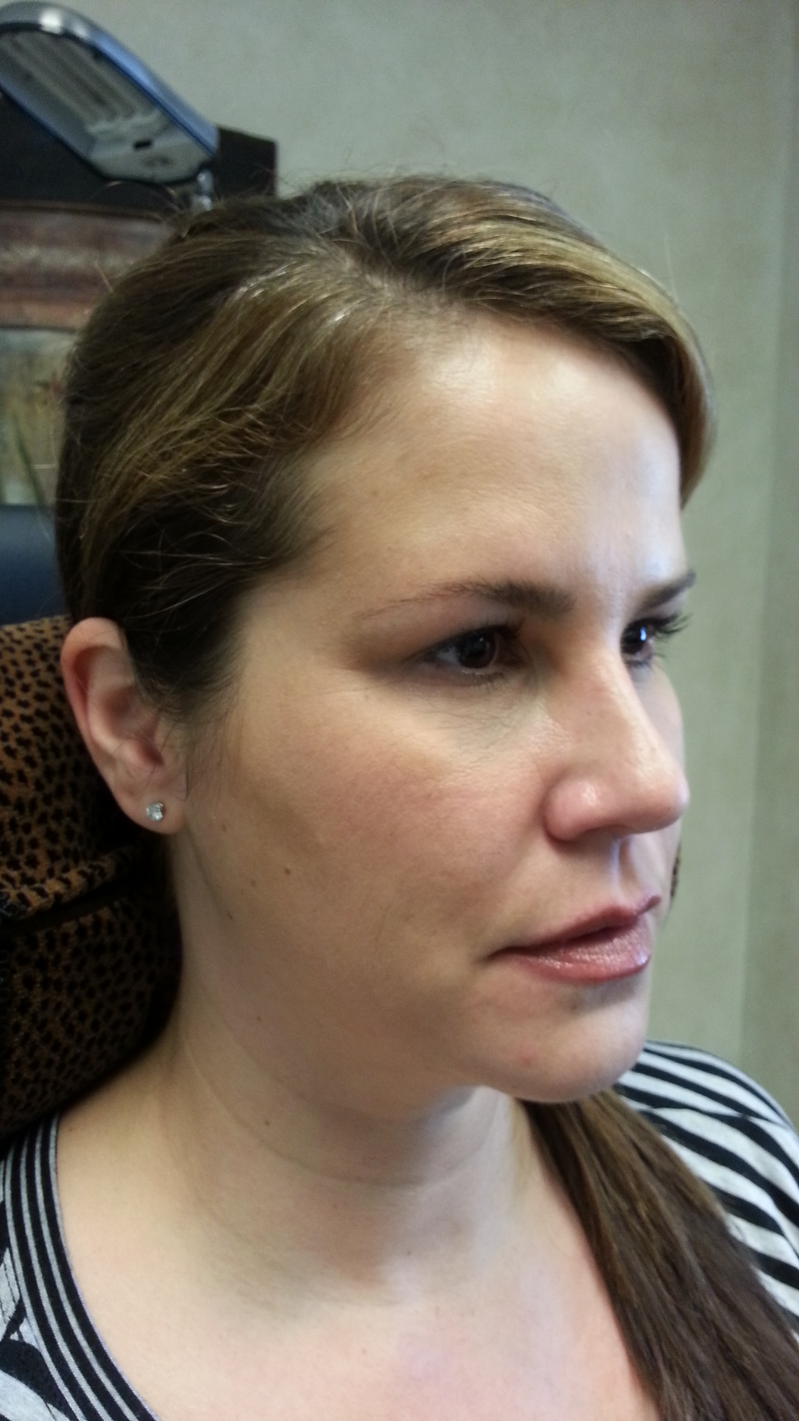 2 cc’s Restylane in the tear troughs and 3 cc’s Restylane Lyft in the cheeks, corners of the mouth, and jowls. (after)