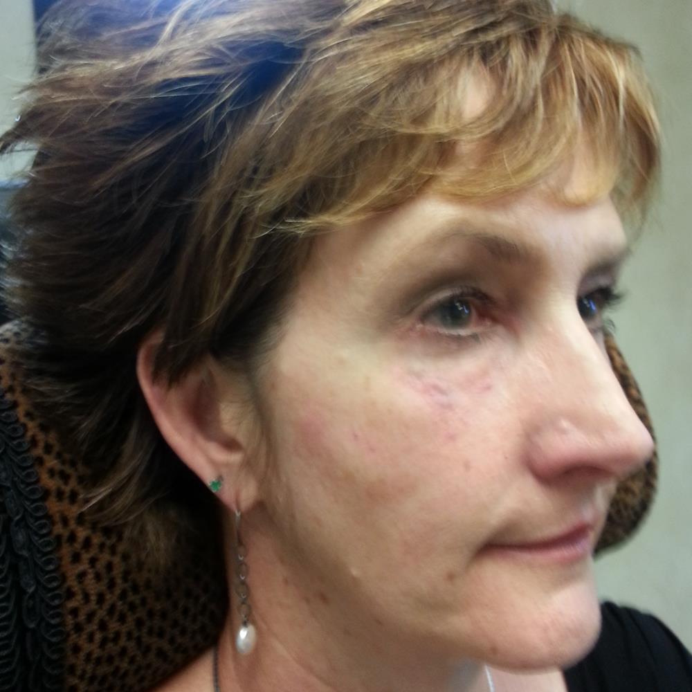 Immediately after 2 cc Restylane in tear troughs and 1 cc Restylane Lyft in cheeks