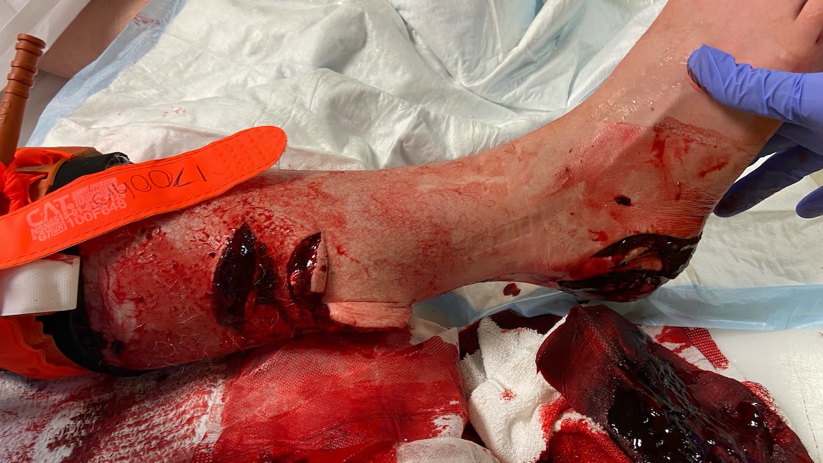 Spearfisherman Survives Bloody Battle with Great White