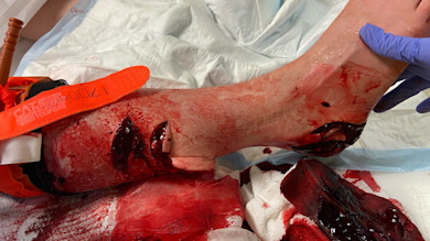 Severely injured lower leg with deep shark-bite wounds and blood, orange CAT tourniquet