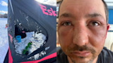 Torn ice-fishing shelter showing pink Esk text and auger; close-up of man with bruised eye
