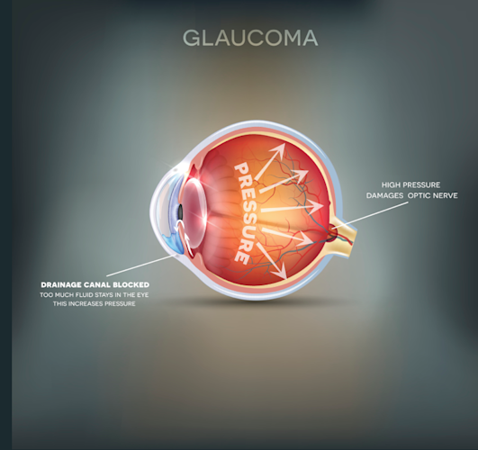 Woman with Glaucoma