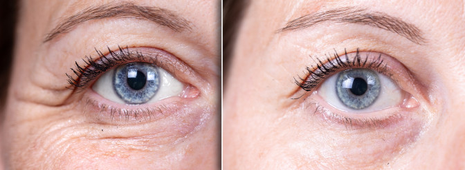 Blepharoplasty eye surgery results