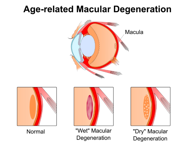 Age-Related Macular Degeneration Diagram
