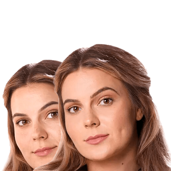 Restylane Lyft Filler Treatment in New York